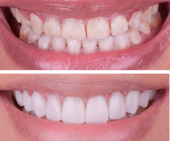 carillas-porcelana-diseño-sonrisa