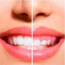 recorte-de-encias-gingivectomia