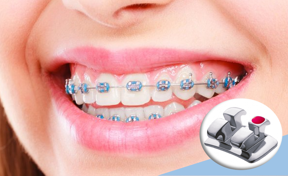 ortodoncia-brackets-cali